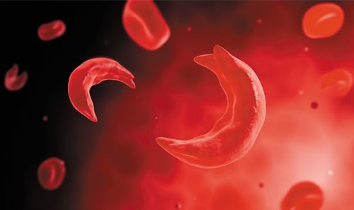 Sickle cell anemia