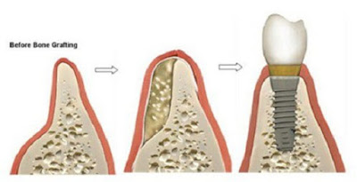 Bị tiêu xương hàm có tiến hành trồng implant được không?