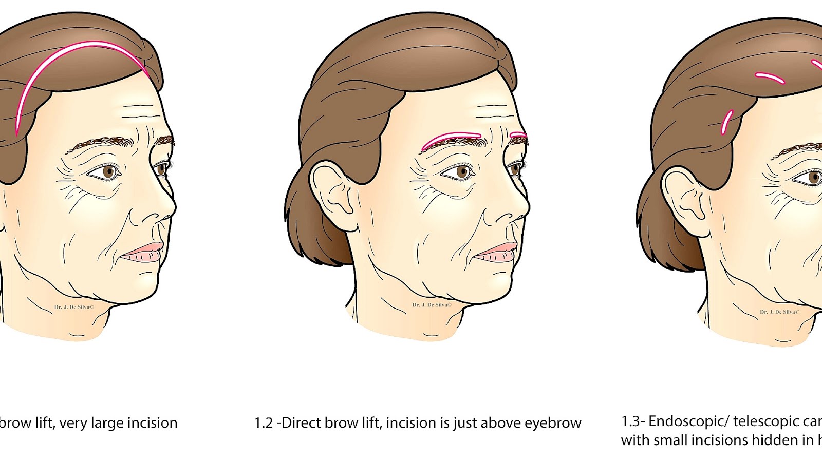 Eyebrow Brow Lift Photos Lift Choices