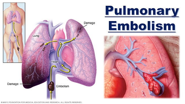  pulmonary embolism
