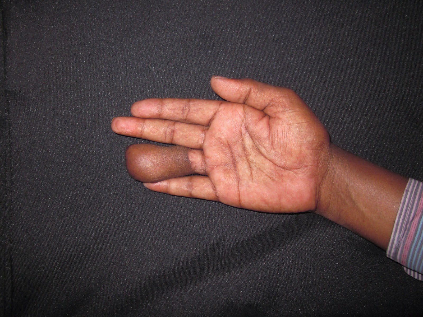 CRUSH INJURIES OF HAND AND UPPER LIMB INJURIES: RING AVULSION INJURY