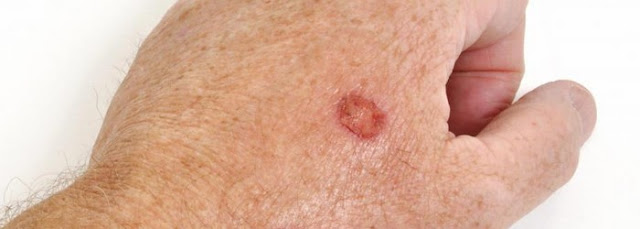 skin cancer sores pictures