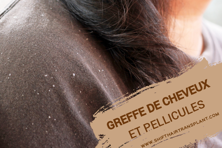 Peut On Faire L Amour Après Une Greffe De Cheveux Greffe de cheveux et pellicules