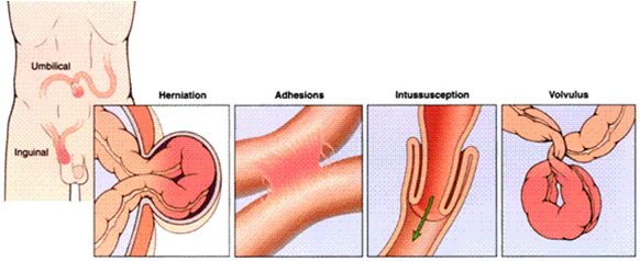 intestinal-obstruction image