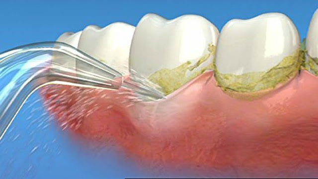 Nhổ răng khểnh có đau không và có nguy hiểm gì không?