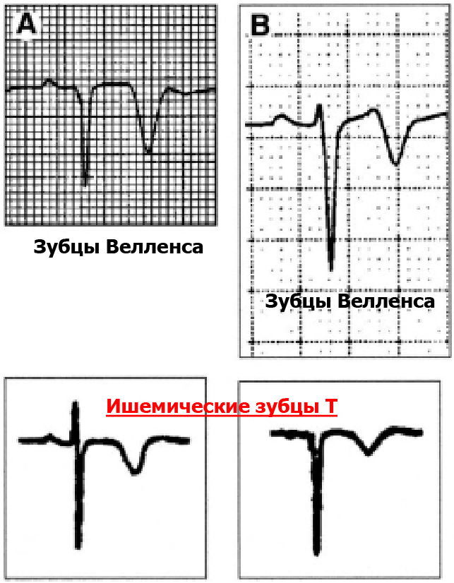 велленс на экг. синдром велленса на экг. синдром велленса и паттерн де винтера. синдром бругада на экг типы. паттерн велленса экг.