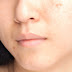 How to Get Rid of Dark Spots on Your Face Fast