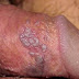 Ciri-ciri penyakit herpes di batang penis dan pengobatannya