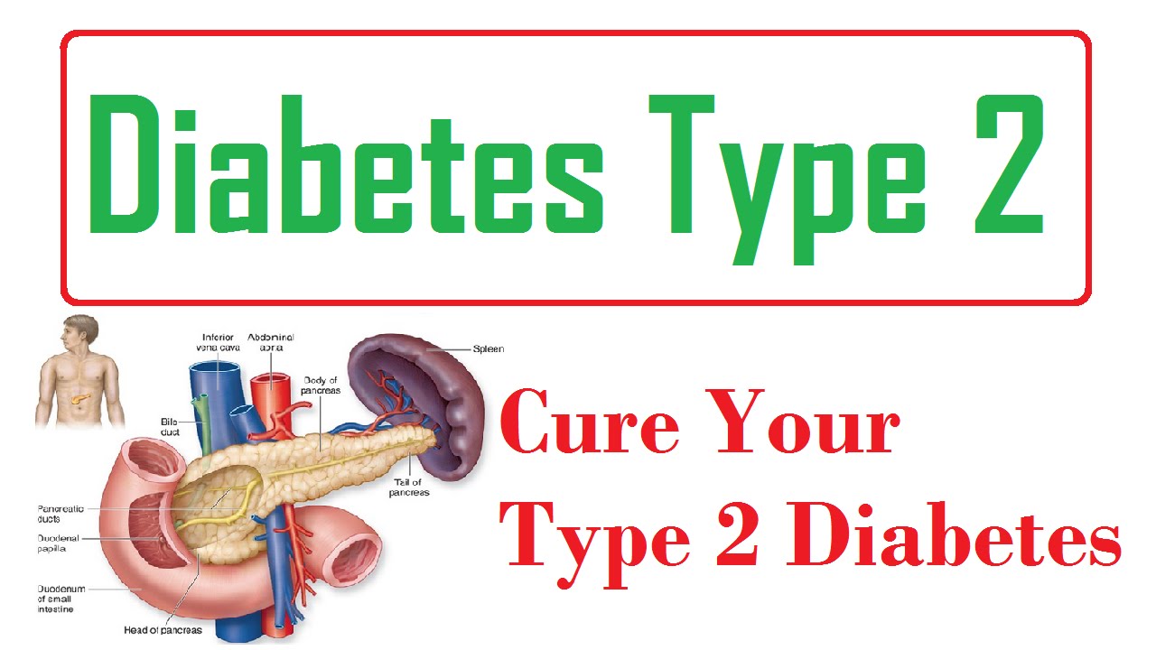 Best cure for diabetes Cure For Type 2 Diabetes Is It Available Now?