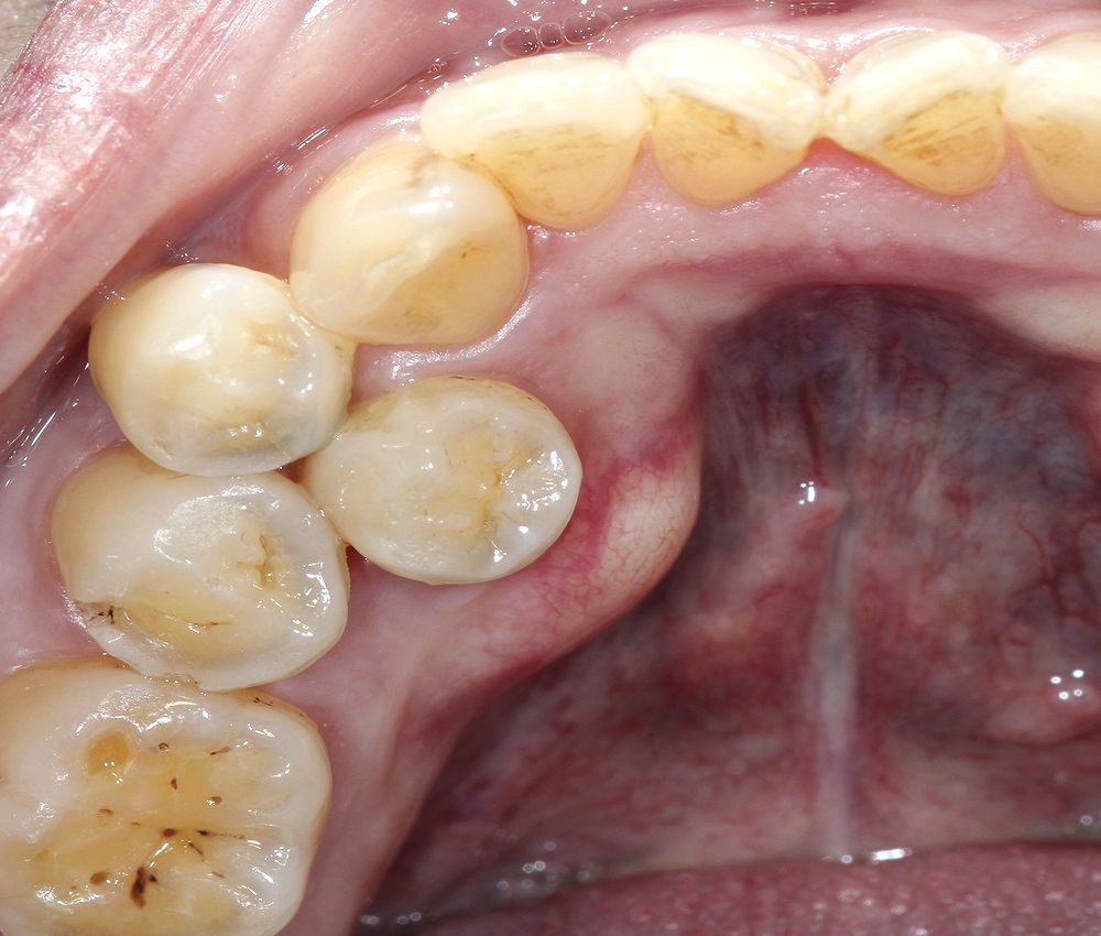 ORAL PATHOLOGY Supernumerary Teeth Directorio Odontológico
