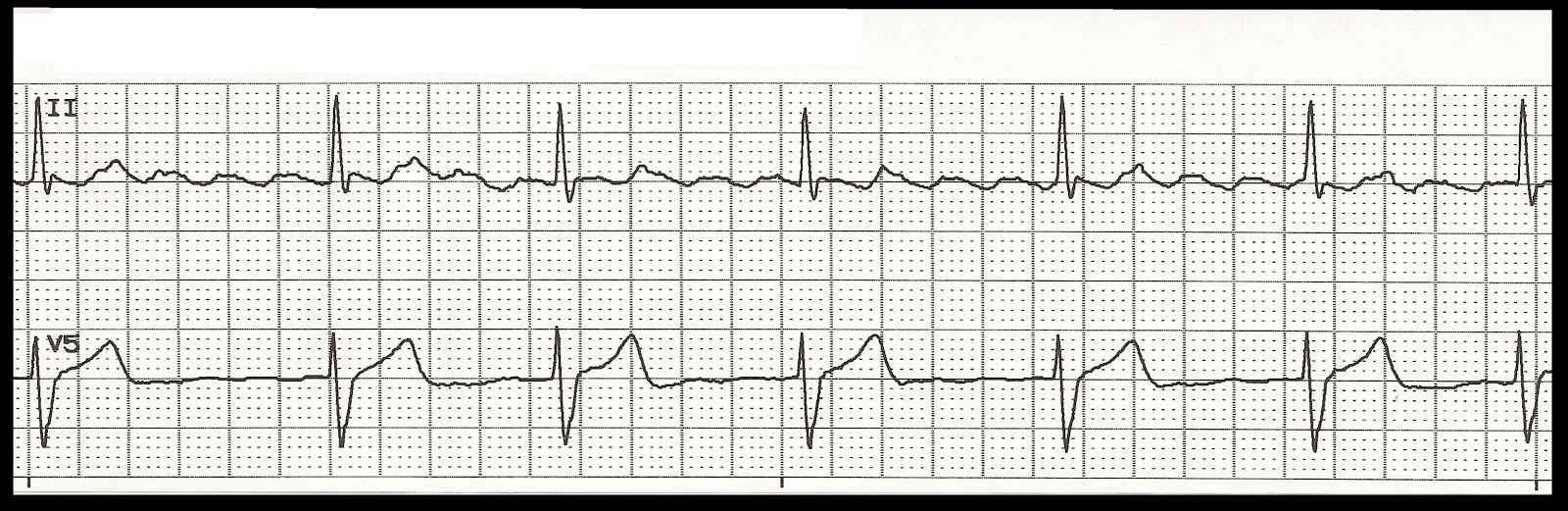 EKG Rhythm Strip Quiz 157