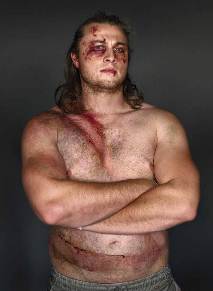 10 Powerful Pictures Of Car Crash Survivors Who Want To Raise Awareness About Seatbelt Safety