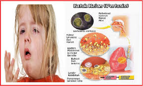 Saat Batuk terasa Sakit Atau Keras? Waspada Batuk Rejan Penyebab Tulang Rusuk Wanita ini Patah