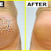 GRANDMA TOLD ME THIS TRICK. IT HEALED MY CRACKED HEELS IN JUST 1 NIGHT