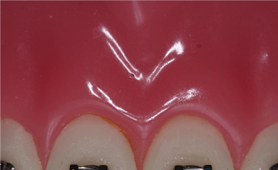 Paslanmaz çelik ligatür model üzerinde (renkli diş teli)