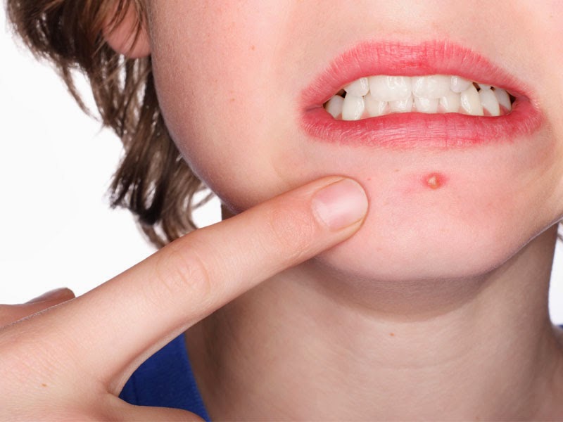 How to get rid of traces of acne after: remove the scars at home