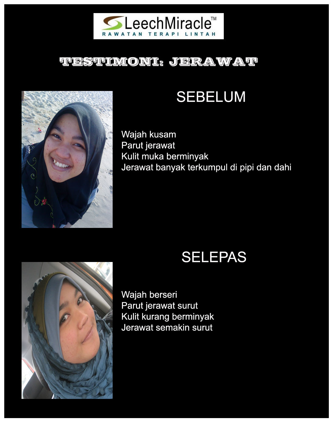 Respeks Group: RG09... [IKLAN] Rawatan Bekam Lintah Leech Miracle