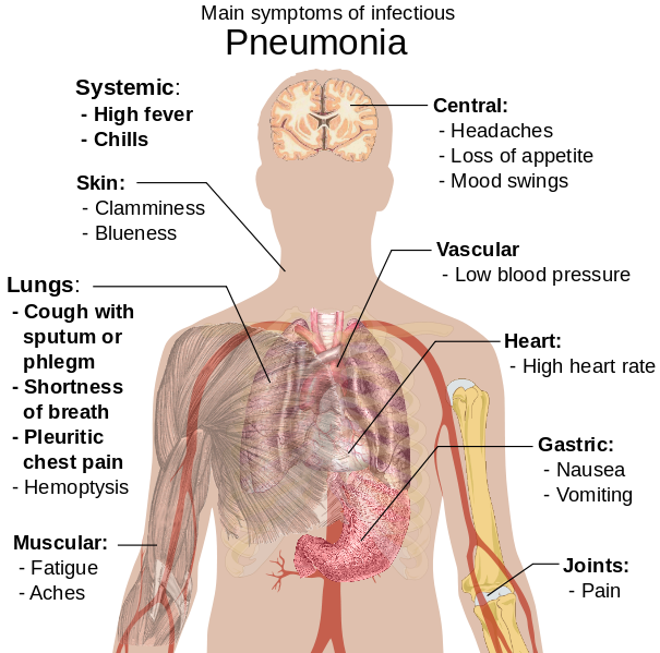 Gejala Paru Paru Basah (Pneumonia) Dunia Alat Kedokteran