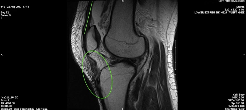 MRI image showing squiggly loose soft tissue where a taut tendon line should be