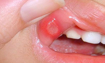 Dieta para adelgazar cachetes carafate