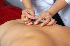 tratamientos de acupuntura
