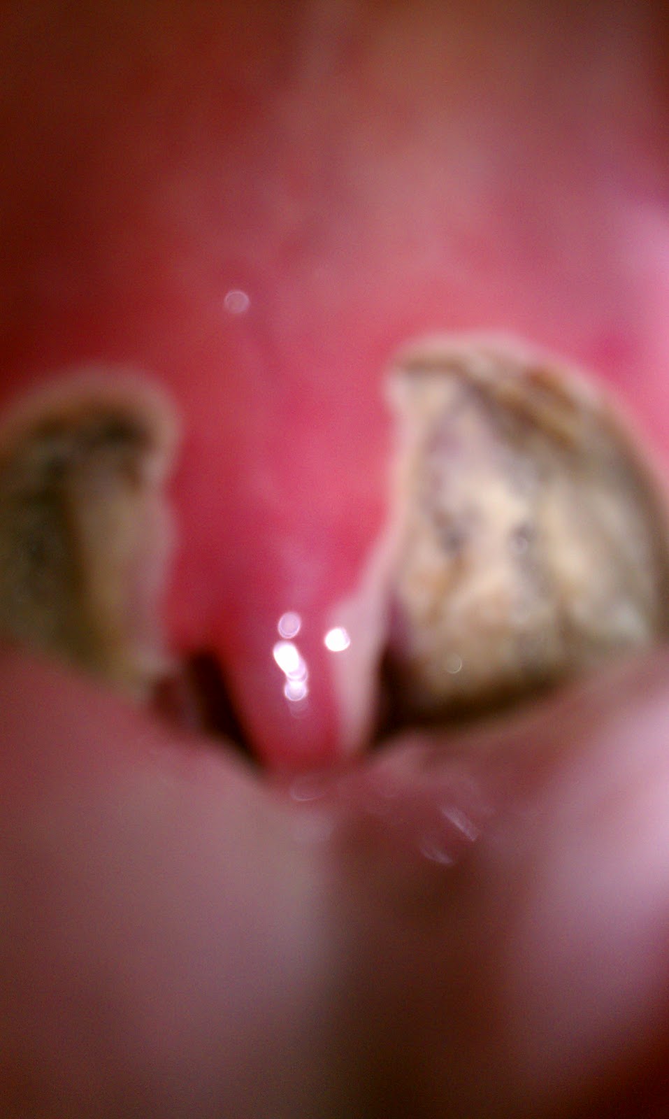 Pictures Of A Normal Throat 69