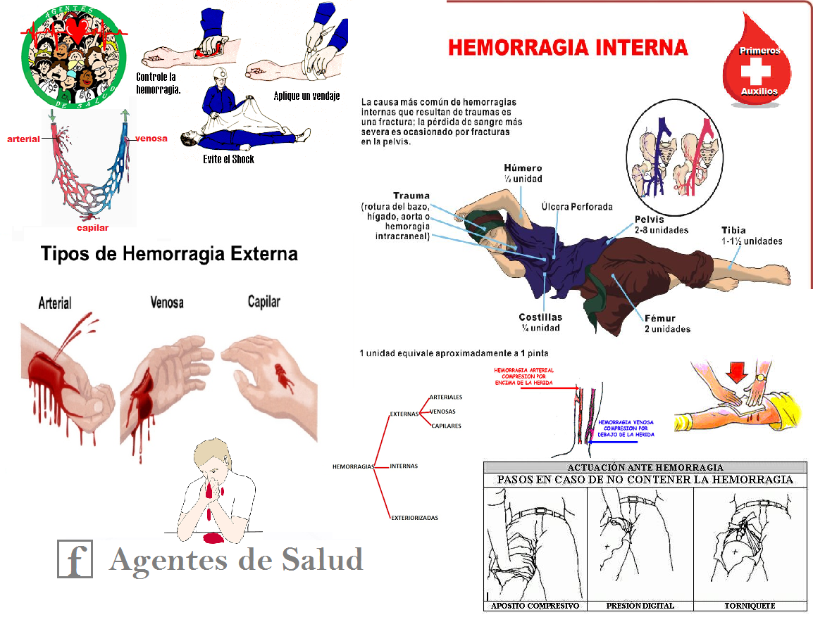 Que Es Y Como Detener Una Hemorragia Inmedicinaorg Images