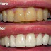 Quy trình tẩy trắng răng chặt chẽ và an toàn