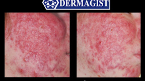 Get Rid Of Acne With Vitamins