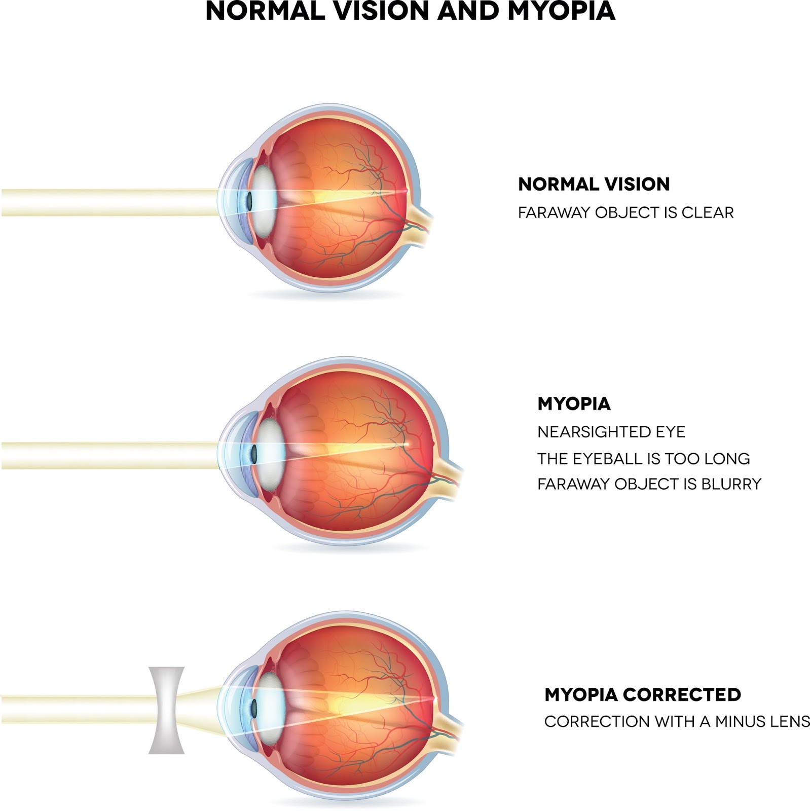 which condition is a common refractive error