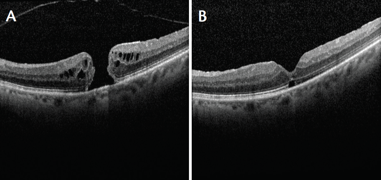 innovations in macular hole repair eyedolatry innovations in macular hole repair eyedolatry