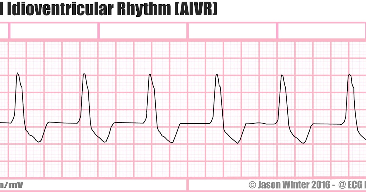 ECG Educator Blog Accelerated Idioventricular Rhythm (AIVR)