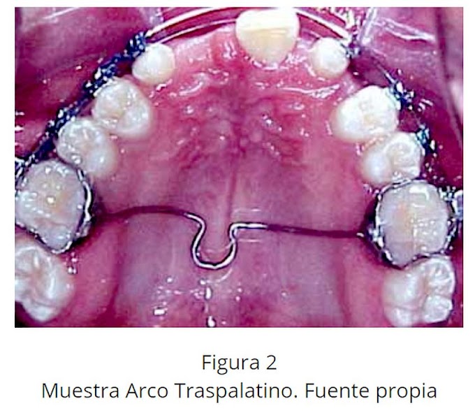 PDF: Pérdida de Anclaje en pacientes tratados con extracción de primeros premolares superiores 