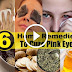 Best Home Remedies To Eliminate For Pink Eye (Sore Eyes) Effectively
