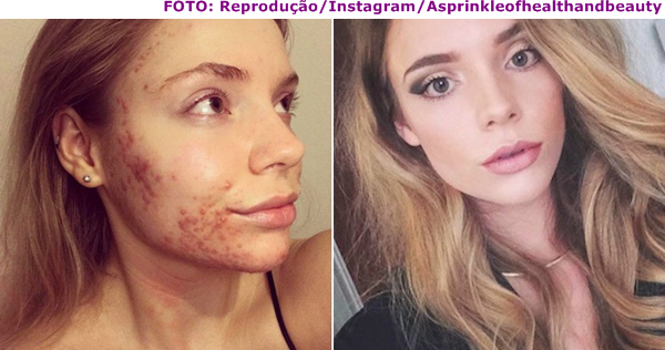 A nata de creme contra o sol do problema fica em frente de respostas de pele
