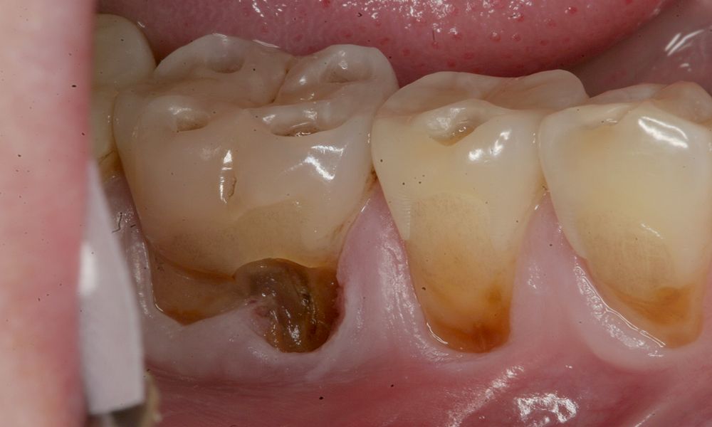 ORAL MEDICINE Acid Reflux and Dental Decay Are they related
