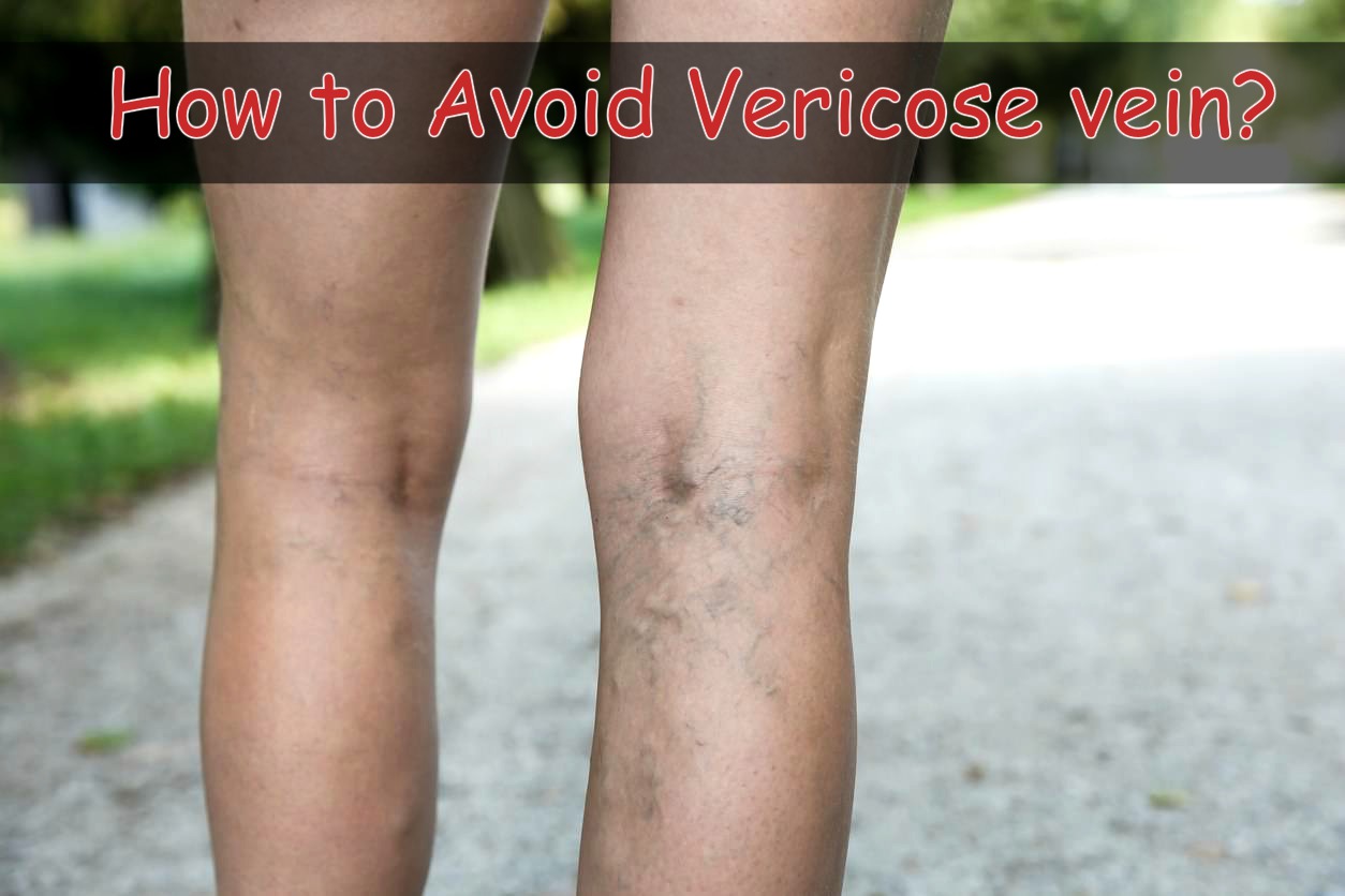 How To Avoid Varicose Veins & Varicose Vein Treatment?