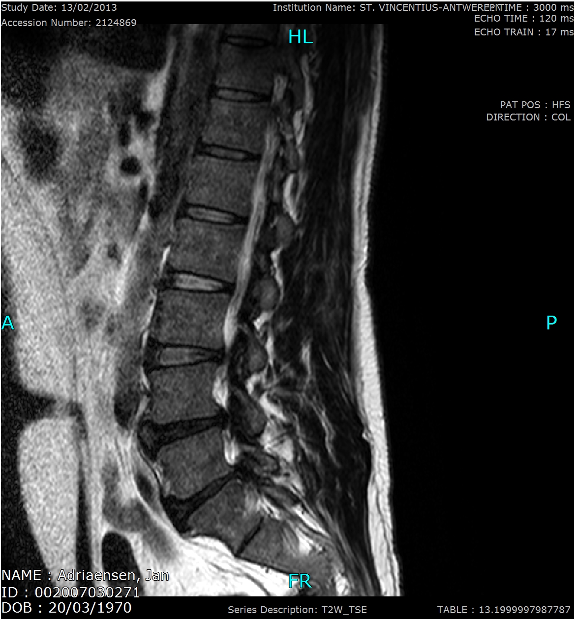 Jangeox' blog: Discusbulging, -protrusie, -hernia