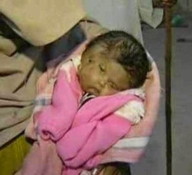 chattisgarh-3-eye-child-born