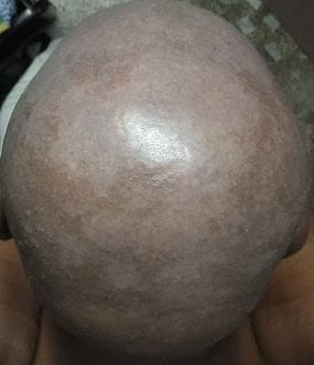 How To Get Rid Of Dandruff : Homemade Remedies 2019 How To Get Rid Of Dandruff : Homemade Remedies 2019