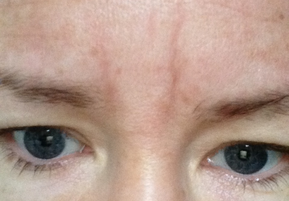 Frownies vs. Surgical Paper Tape & 1 YEAR UPDATE