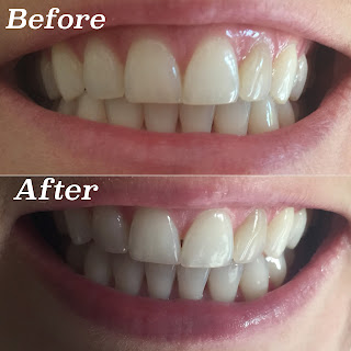 Smile Brilliant Before and After Results 