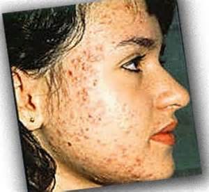 Acne Know The Types Of Acne And How Handling