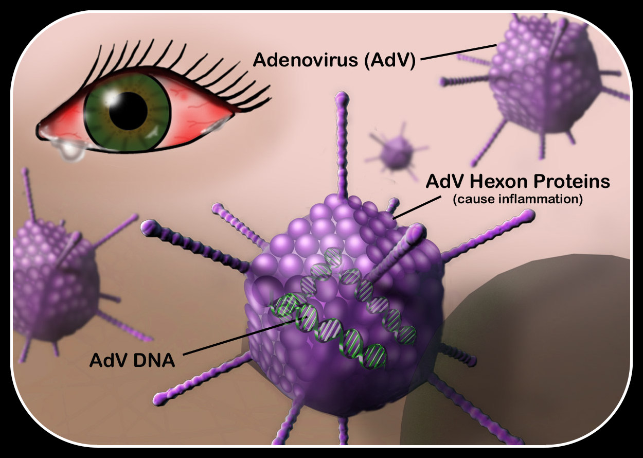 Аденовирусная инфекция этиология. Аденовирус патогенез. Глазная инфекция аденовирус. Аденовирусная этиология. Аденовирус гриппа