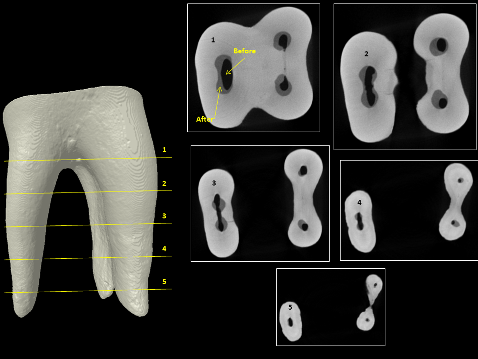 The Root Canal Anatomy Project Root Canal Preparation GatesGlidden
