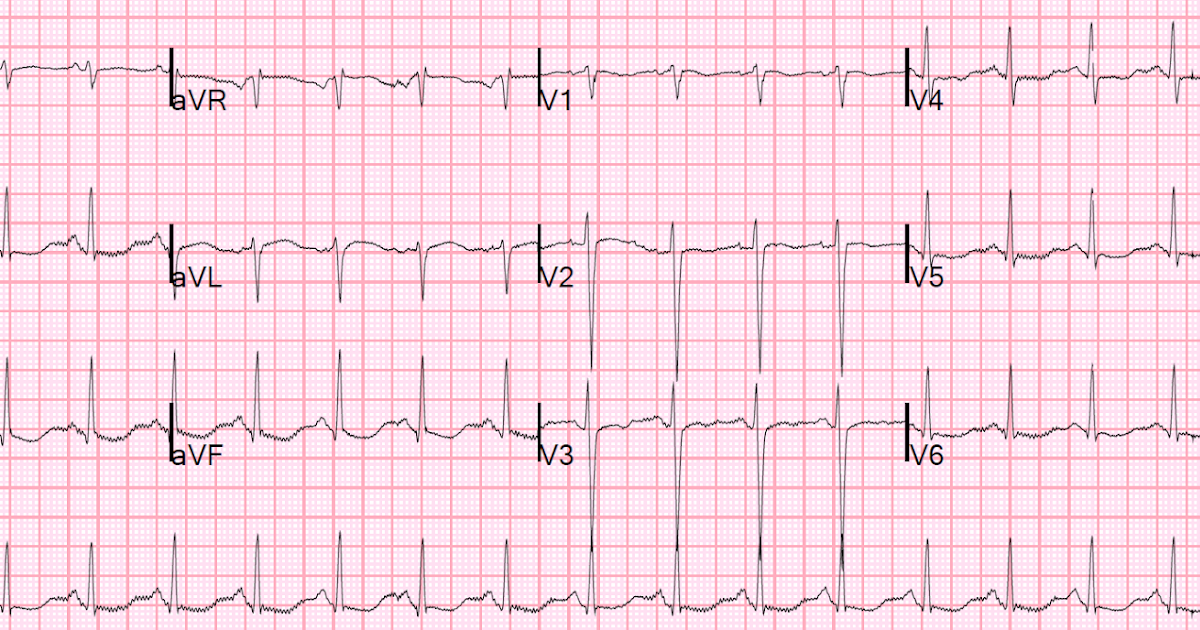 Dr. Smith's ECG Blog Massive caffeine overdose How does the ECG fit in?
