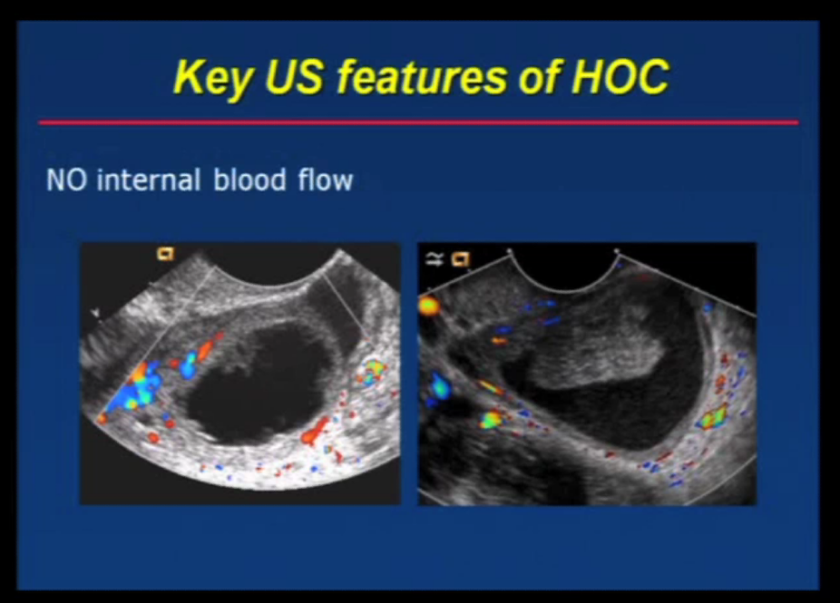 rsna hemorrhagic ovarian cyst