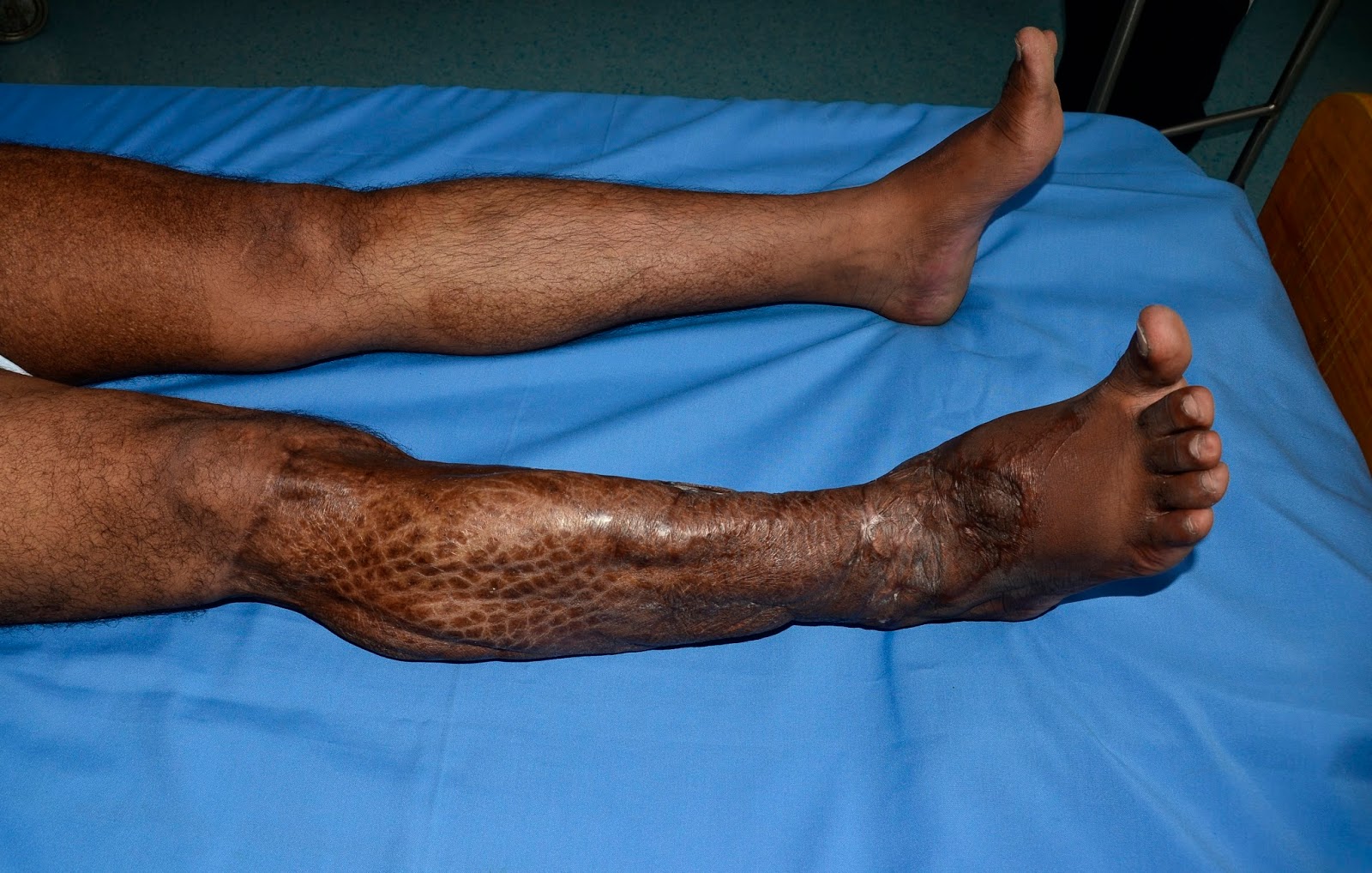 Crush Injury Foot Lower Limb Injuries And Limb Salvage Major
