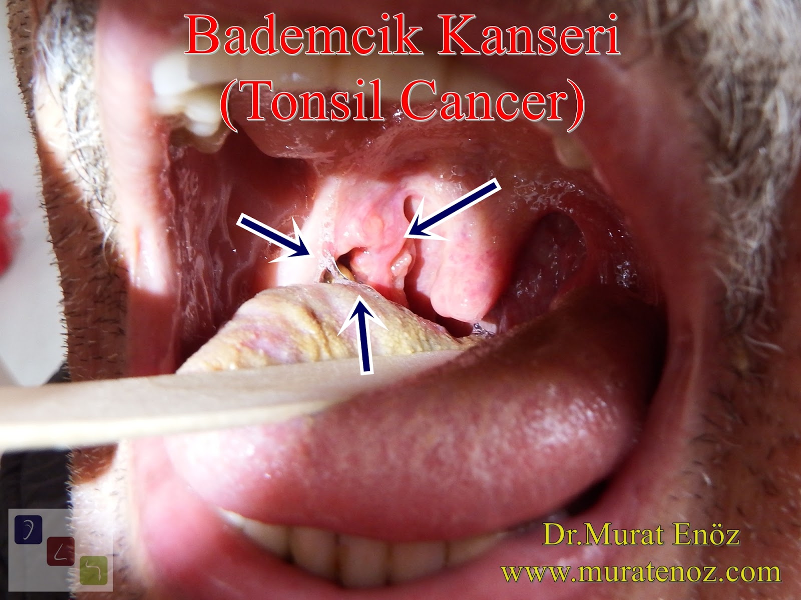 lingual tonsil cancer symptoms