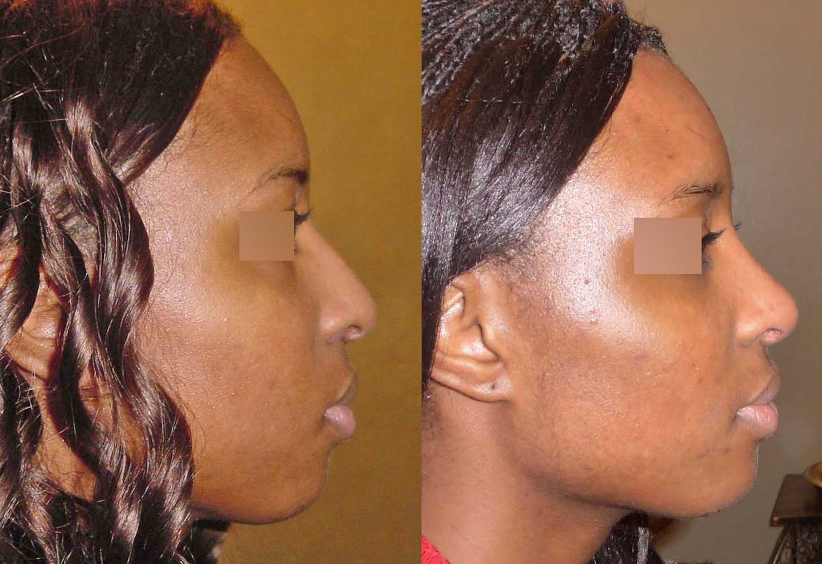rhinoplastie ethnique et greffe costale